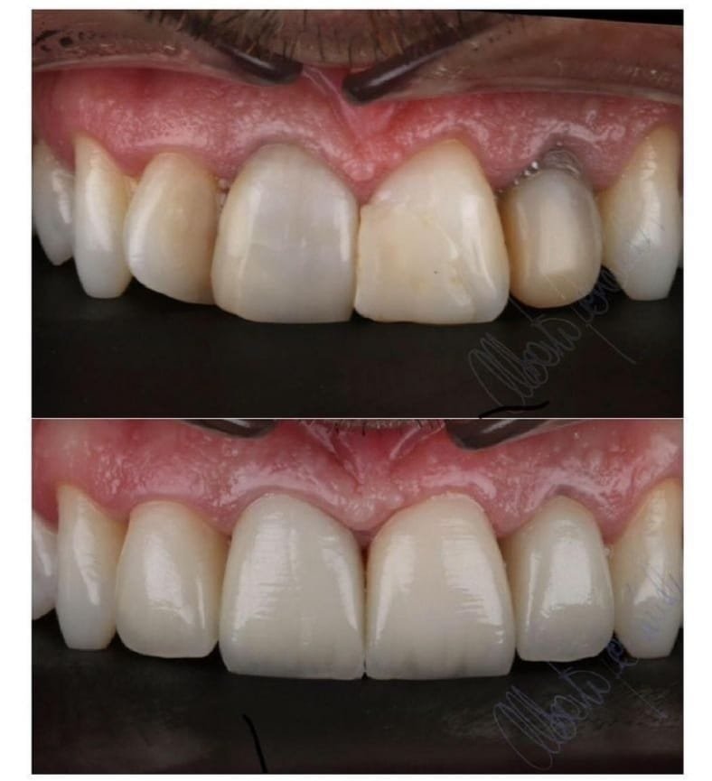 Caso Clínico: Rehabilitación Estética de Incisivos Superiores