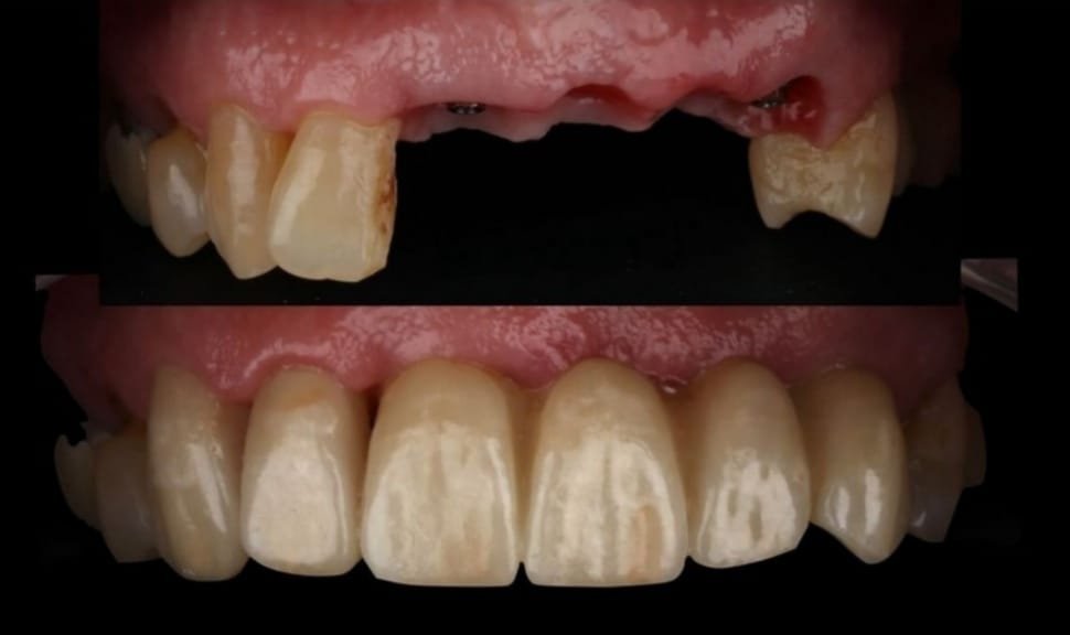 Caso Clínico: Rehabilitación Protésica de los Incisivos Superiores con Enfoque Estético