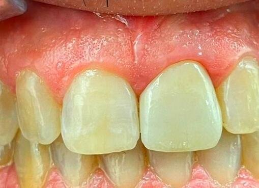 Caso Clínico: Restauración Estética de Incisivo Superior