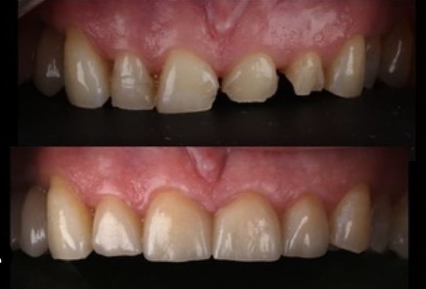 Caso Clínico: Rehabilitación Estética de los Incisivos Superiores con Carillas de Porcelana